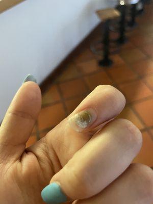 Fungus grew under my nail!