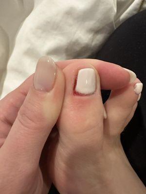 Infected toe. Thick splotchy gel