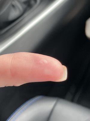 I was handed a very hot plate after my food took 40 minutes to get. I have 3 burn blisters.