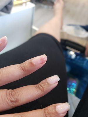 Ripped nail