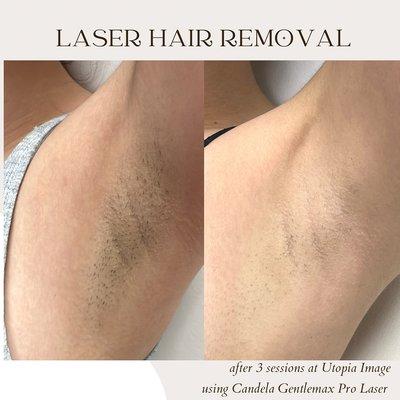 Hair reduction after only 3 sessions of laser hair removal.