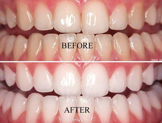 Shanabo Dental offers whitening treatments to achieve that pearly white smile!