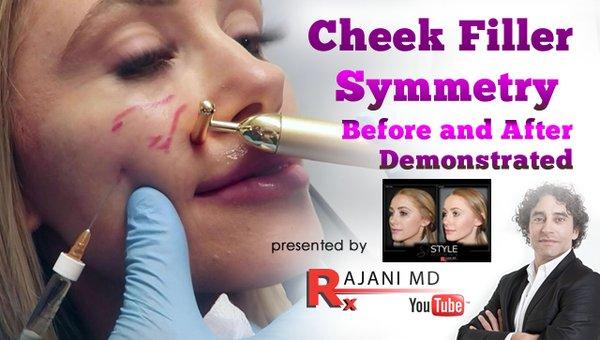 https://www.youtube.com/watch?v=w1izopi8qIs
 
 Dr Rajani injects dermal filler for cheek symmetry. Cheek Augmentation - Portland, Oregon