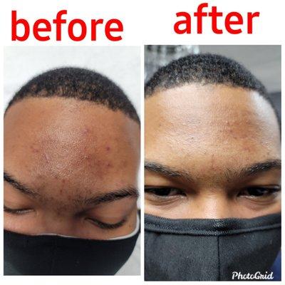 Microneedling after first treatment...