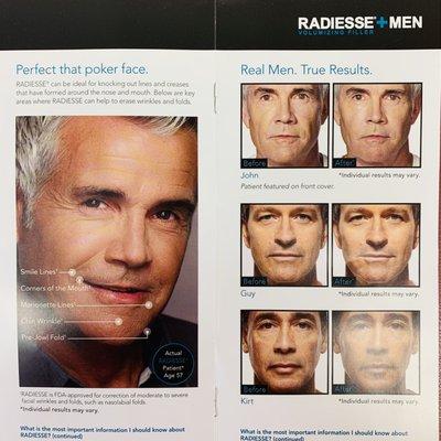 Radiesse fillers for Men. Amazing anti-wrinkle results!