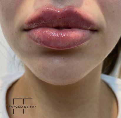 Lip Augmentation by Nurse Fay.