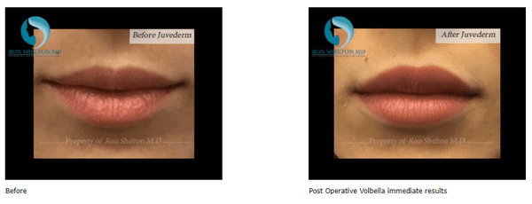 Lip Augmentation before and after