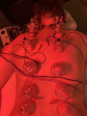 cupping and electro-accupuncture