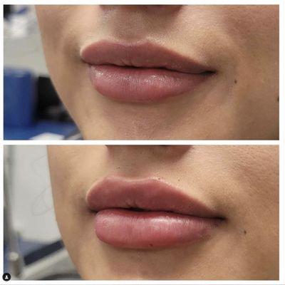 Before and after lip filler using Restylane Kysse.