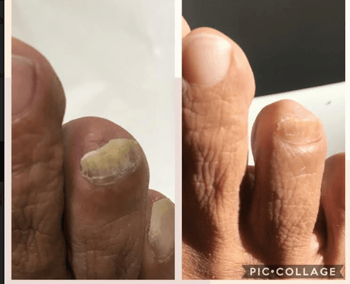 Before & After-Toe nail fungus.  Actual results after 1 treatment