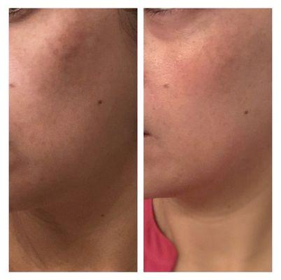 Left: melasma on left side of cheekbones. Right: after Perfect Peel.