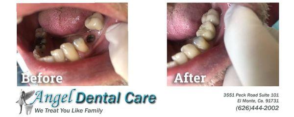 Dental Implants from Angel Dental Care of El Monte.