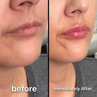 Lip filler with Juvederm