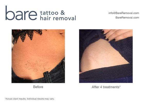 Complete laser tattoo removal by Bare Tattoo & Hair Removal.