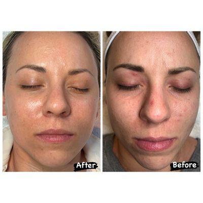 Chemical peel before and after