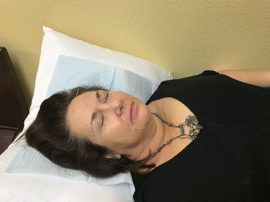 Holiday Beautiful- Acupuncture Facelift