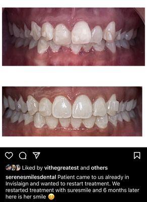 Clear aligners with Dr. Ta - results!