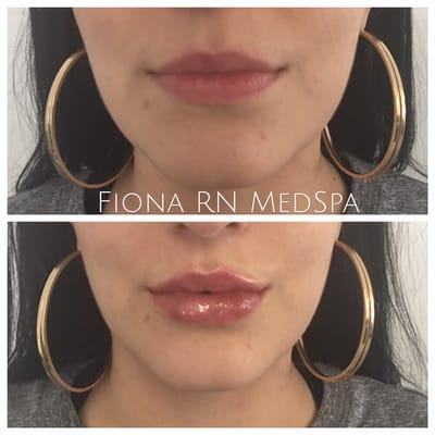 Lip injections with juvederm and restylane