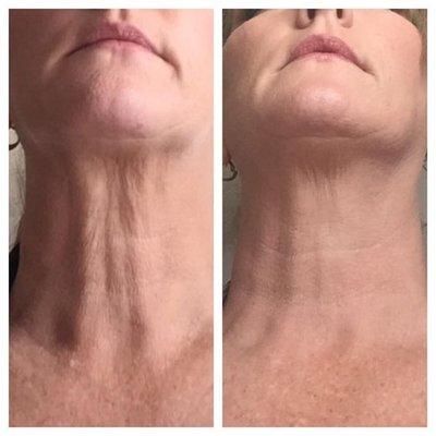 Fascia Blasting results on the neck.