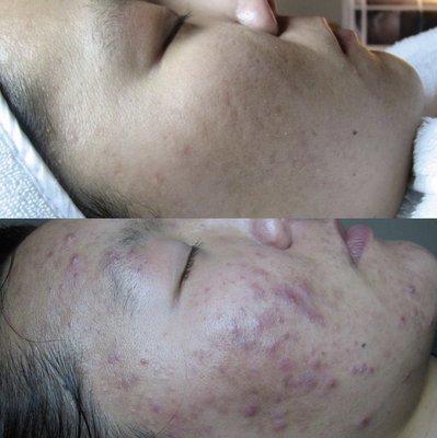 Acne Bootcamp