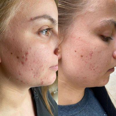 Acne facial done by Esthetician Ashleigh