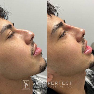 Non-surgical nose job