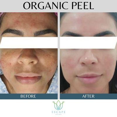 Organic Peel