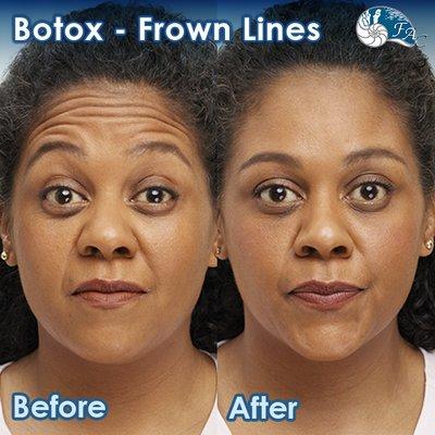 Botox: Frown Lines: Before & After Results Please Call (949) 313-2600