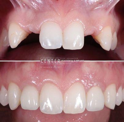 Multiple dental implants in Los Angeles, CA to help restore this patients smile. Patient was missing her two lateral incisors.