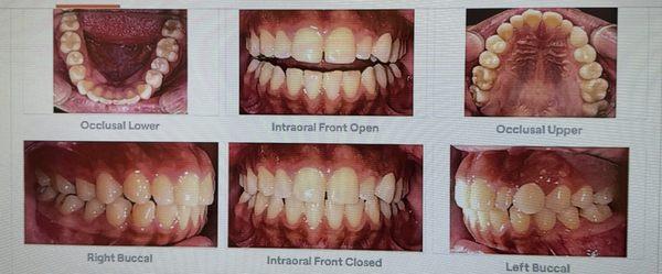 Clear aligners