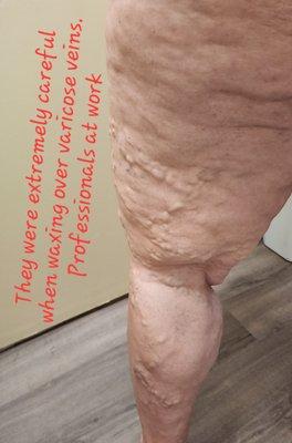 Extra care taken on varicose  veins which shows how great the teacher does her job.