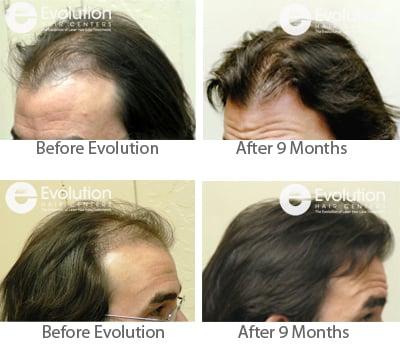 Men's Hair Loss Treatment Results after 9 Months