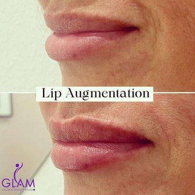 Lip Filler using 1 syringe