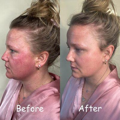 Rosacea cleared after facial treatments