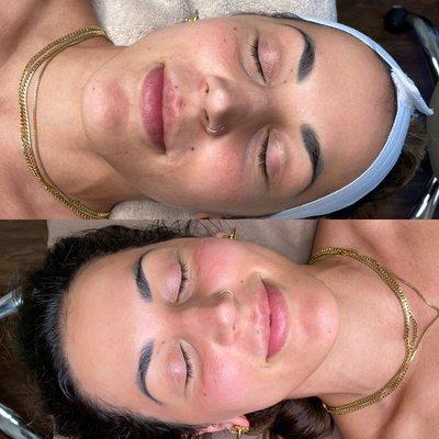 Enzyme dermaplane treatment