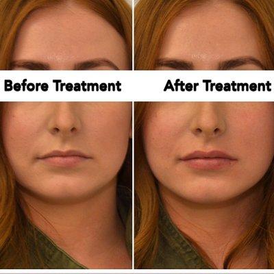 Lip Augmentation Before and After Photos