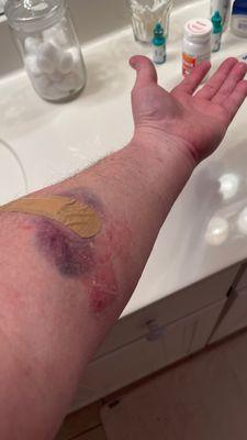 Excessive bruising and allergy to the tape being used.