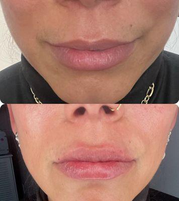 Patient results with juicy lips !