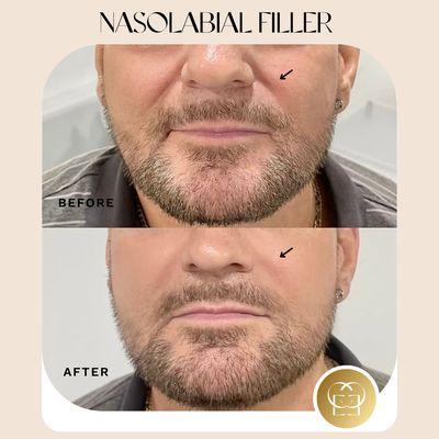 Nasolabial filler