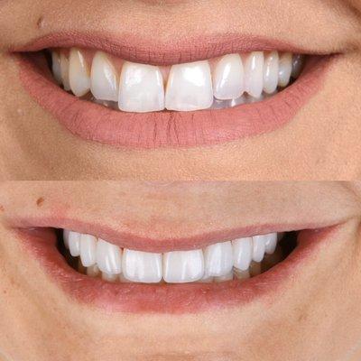 Veneers that are organic and translucent done by our cosmetic dentist, Dr. Kasra Tajik