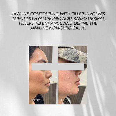 Did you know you can use filler for facial contouring? Placing the filler in certain areas can help enhance a natural "contoured" look!