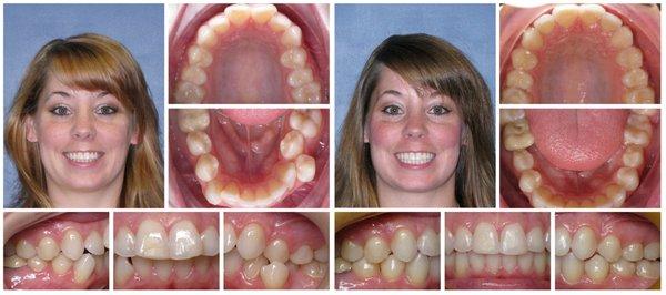 invisalign case