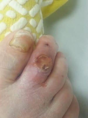 Severe MRSA infection