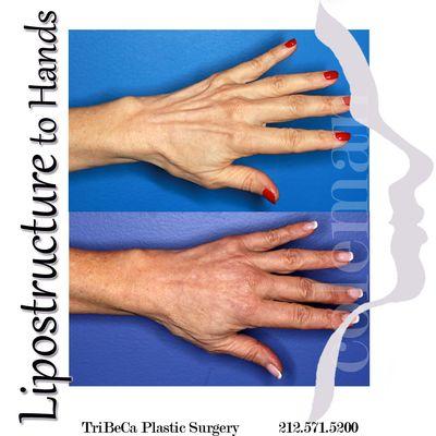 Great results of fat transfer to the hands for rejuvenation.