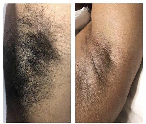 A before and after underarm sugaring service.