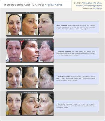 Chemical Peel Follow-Along DermLA.com