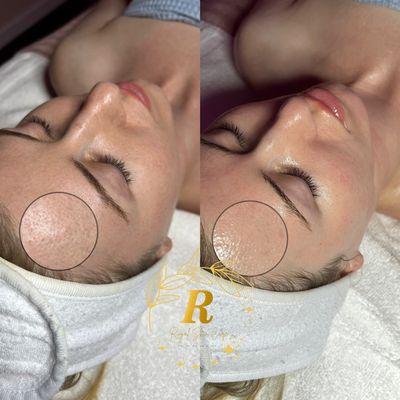 Deluxe Glowing Oxygen Treatment (1st session)