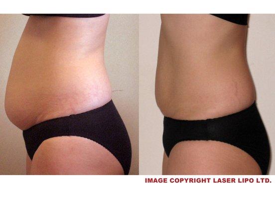 Strawberry Laser results in instant inch loss!