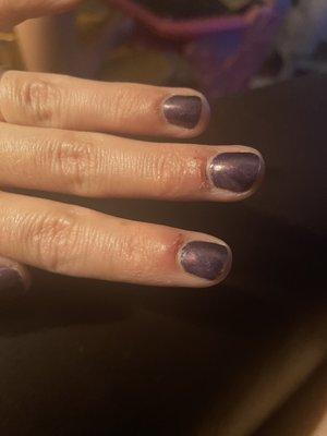 Infection in nails