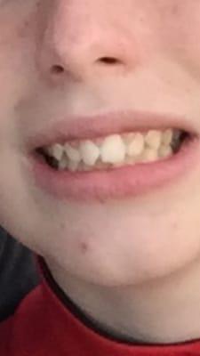 Chipped front tooth "BEFORE".